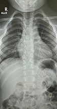 Csigolyafejlődési rendelenesség - röntgen