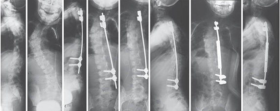 Csigolyafejlődési rendelenesség - röntgen
